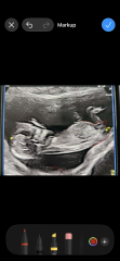 Can anyone help interpret my scan and nub theory guess?