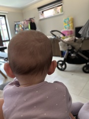 Baby flat spot on head