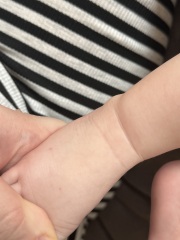 Baby rash on feet