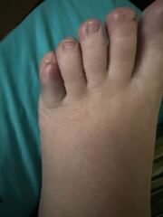 Broken (I think) toe
