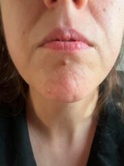 DD 17 mole with black hairs sprouting from it mole is fine can anything be done about the hair ?