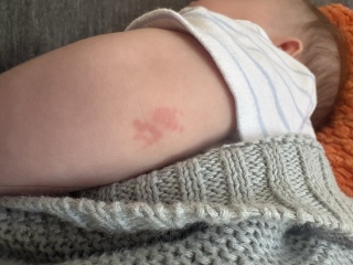Rash on baby