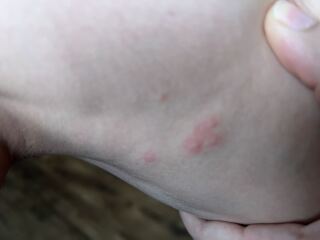Bed bugs!