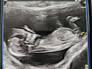 Can anyone help interpret my scan and nub theory guess?