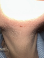 Mole 2ww