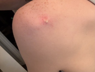 Pictures of recent sebaceous cyst contents