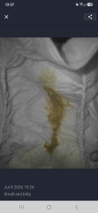 CMPA query *[Content warning: nappy pics included]