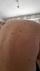 Are these bedbug bites?