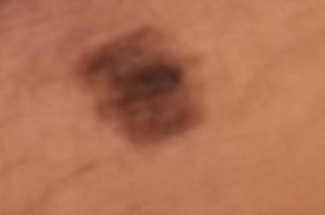 Concerns over a freckle type thing on my leg