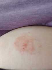 Weightloss patches, has anyone tried them.