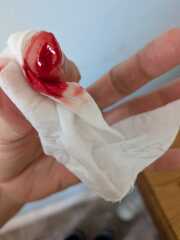 Gruesome (minor) accident