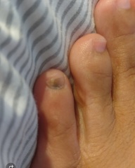 To have scared myself about melanoma on my pinky toenail?