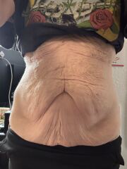 Has anyone stayed on a low dose of Mounjaro rather than increasing?