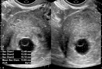 Six-week scan with no fetal pole yet, anyone had similar?