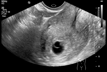 Six-week scan with no fetal pole yet, anyone had similar?