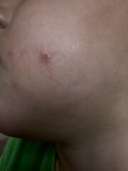 Is this molluscum contagiousum?