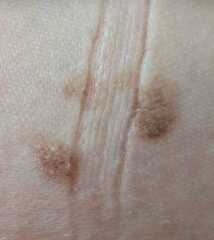 GP for these moles?