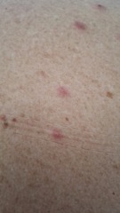 Are these bedbug bites?