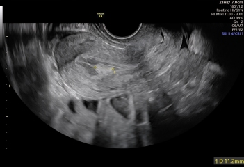 Negative pregnancy test, possible polyp and unusual scan findings