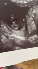 Doubts after a rushed 15-week gender scan showing a possible boy