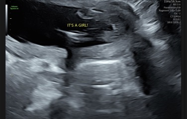 Do these 17-week scan photos suggest a girl to you too?