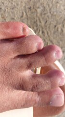 To have scared myself about melanoma on my pinky toenail?