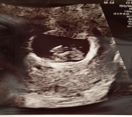 Any guesses on gender using Ramzi theory at 8 weeks +4 scan