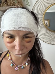 Awaiting facelift surgery tomorrow, and would appreciate positive thoughts and advice