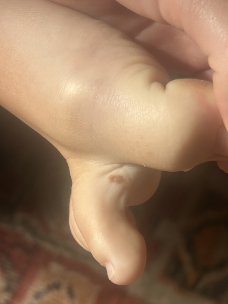 Does this look like a melanoma on DDs toe?