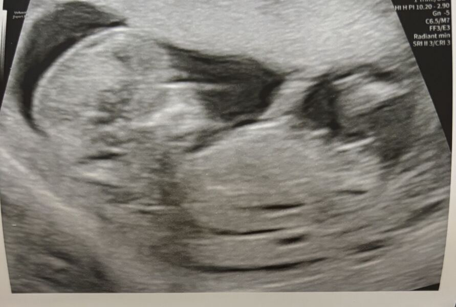 Any guesses on nub theory at 12 weeks and 2 days?
