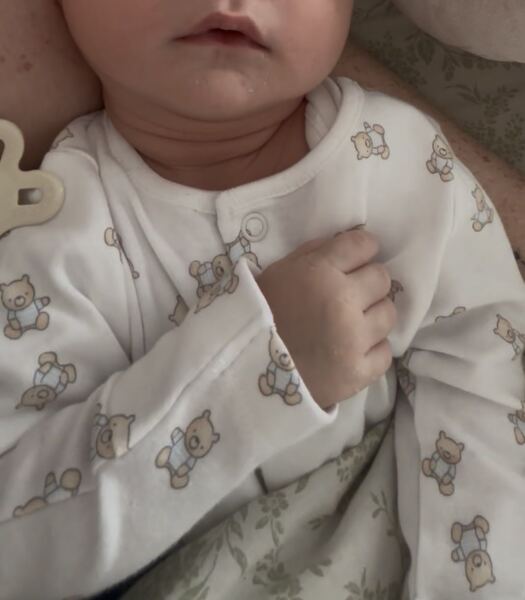 3 week old skin discolouration during/after feeding