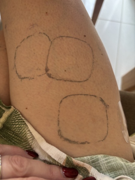 Any tips for removing marks left by menopause patches?