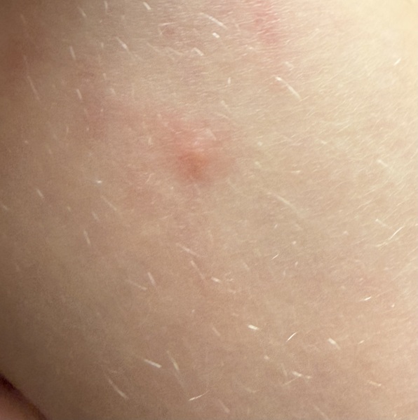 Chickenpox? Or just a viral rash?