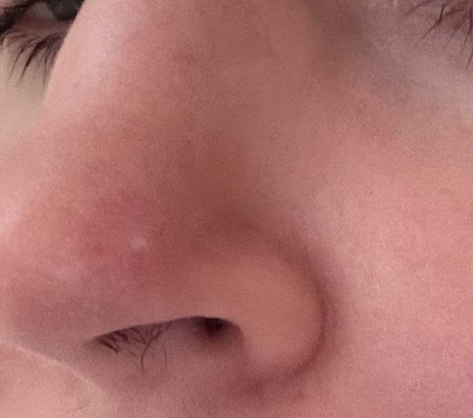 Worried about a white spot on my nose , any doctors on here.