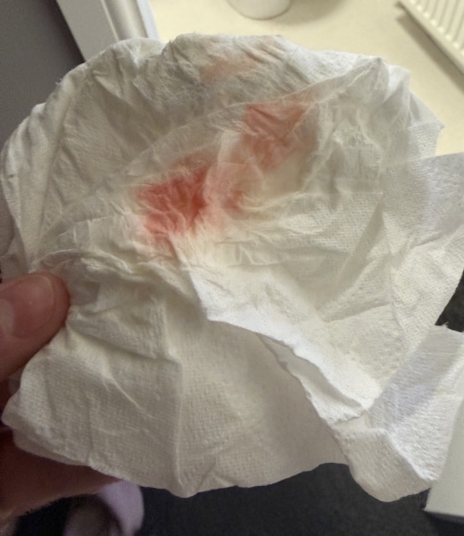 Bleeding at seven weeks after seeing heartbeat, anyone had similar?