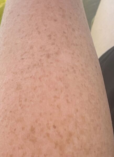 Would you consider laser treatment for larger freckles or try to embrace them?