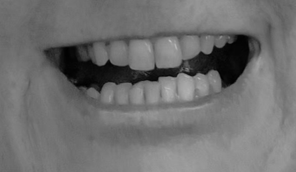 Do DC really need teeth removed for braces?
