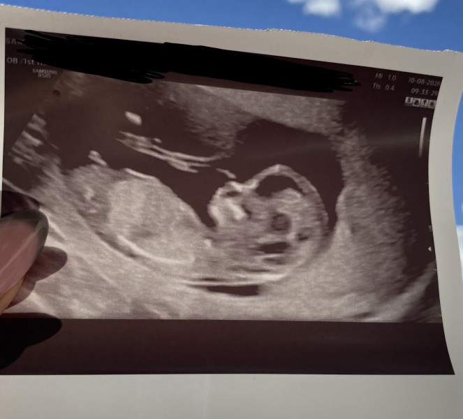 Nub theory guesses after my 12 week dating scan - responses would be greatly appreciated :)