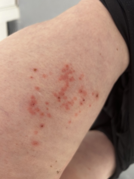 Shingles ??