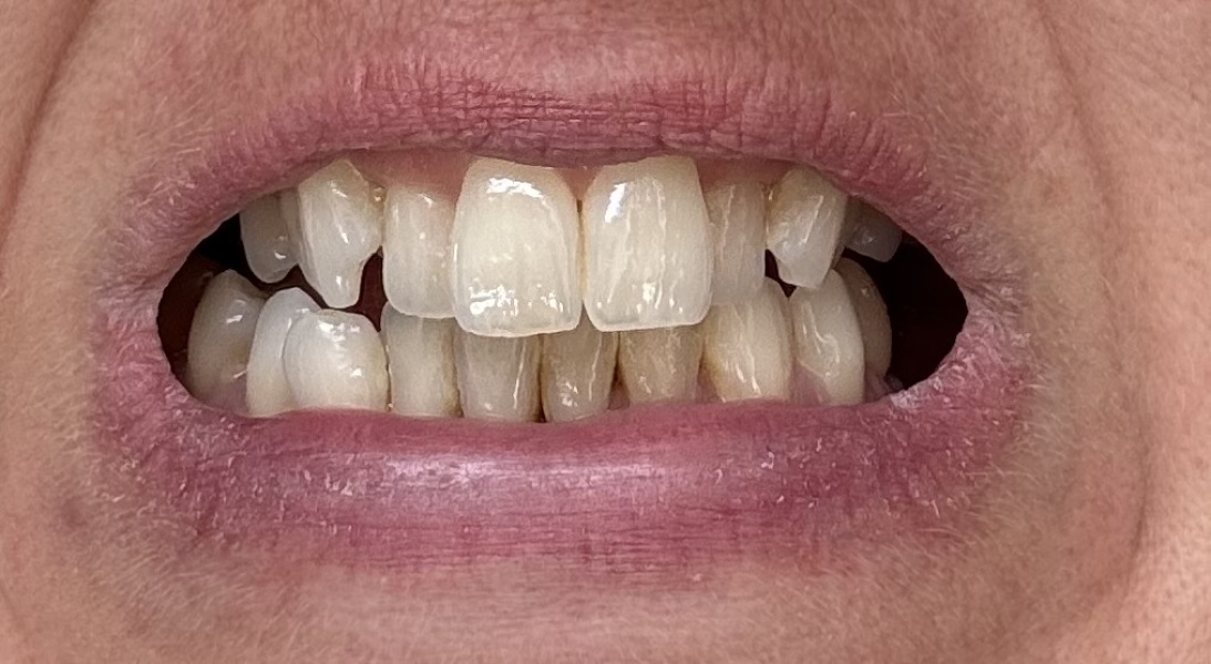 Has anyone straightened their teeth with clear aligners this quickly?