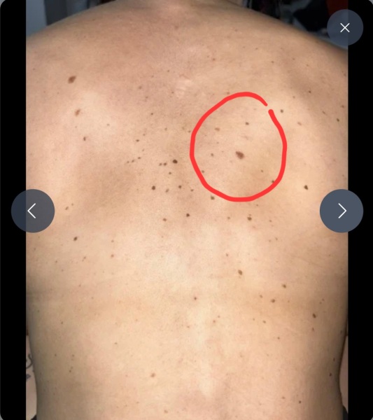 worrying moles on my back?