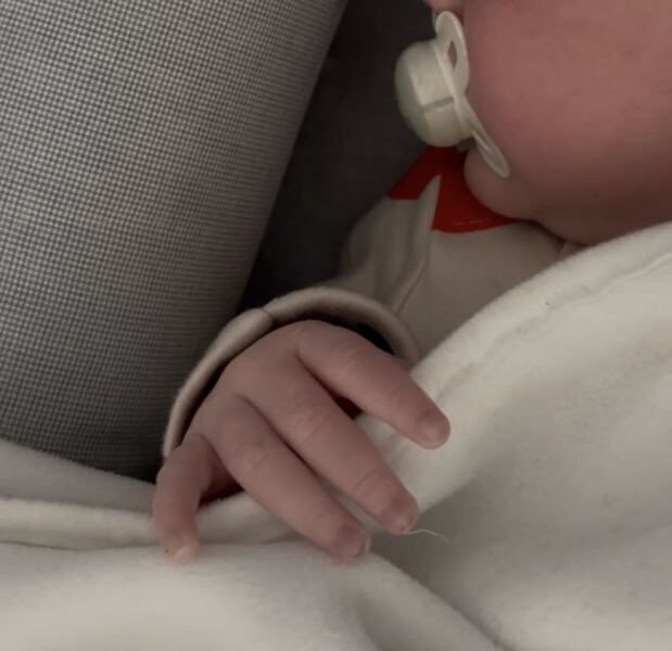 3 week old skin discolouration during/after feeding