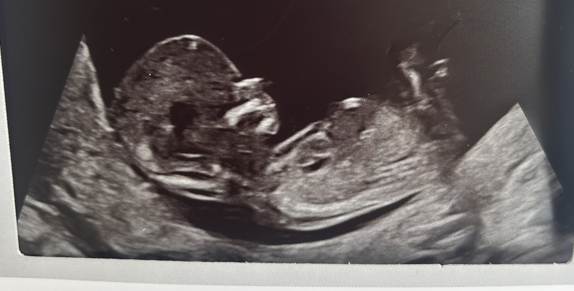 Any guesses on this 13+5 week pregnancy scan?