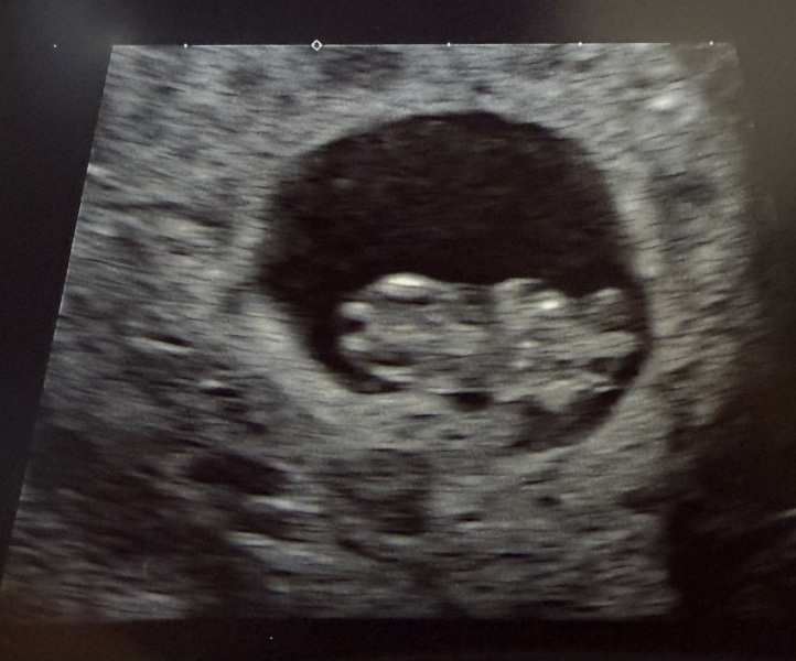 Any Ramzi method guesses for this 9 week abdominal scan?