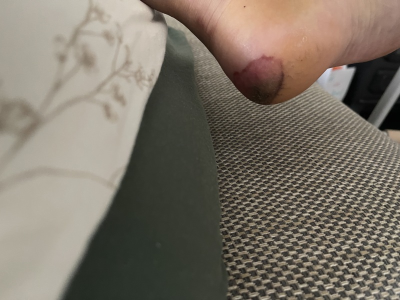 Concerned about heel pressure sore after tibia surgery, should I seek help?