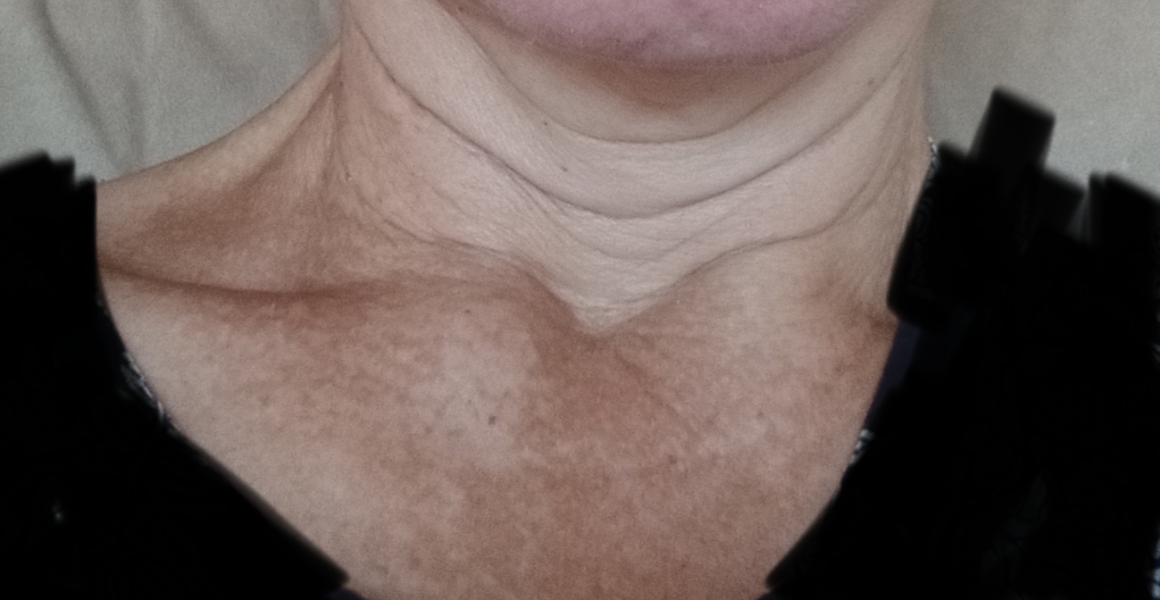 Saggy neck photo!