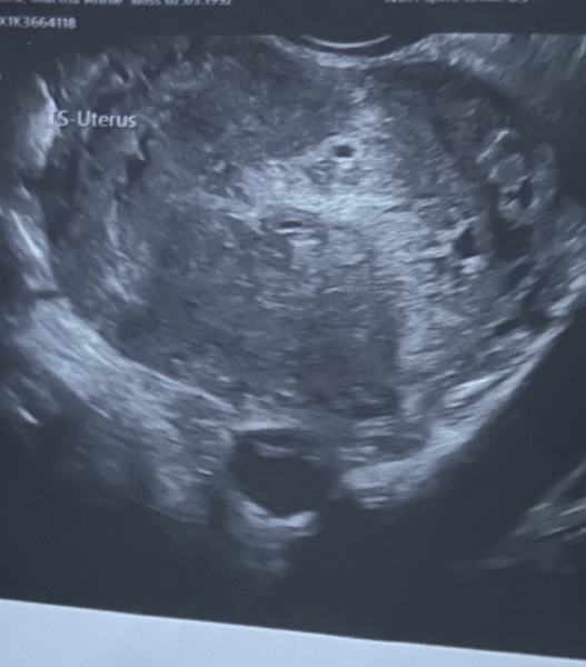 Asked to return after early scan due to possible partial molar