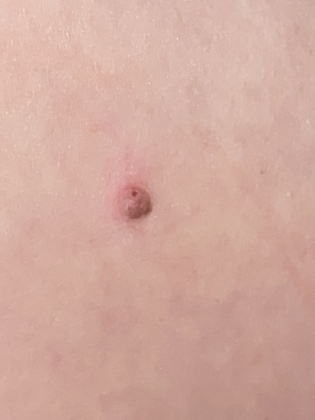 WTF is this- nipple on my arm
