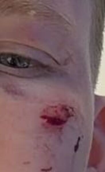 DS split his cheek playing rugby while away with school. Can anyone with first aider knowledge reassure me? Photo attached.