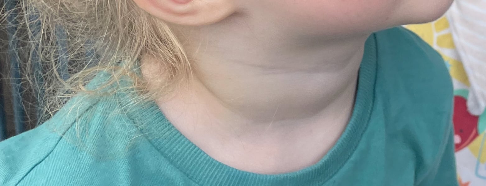 Does this look like a potential sign of hyperthyroidism in 18mo?